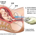 【画像】中絶、めちゃくちゃ残酷だった　中絶まんさんってただの人殺しだろ